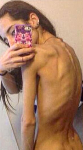 girl suffered anorexia 