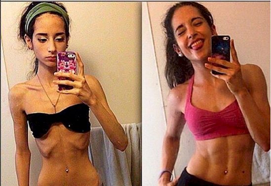 girl suffered anorexia 