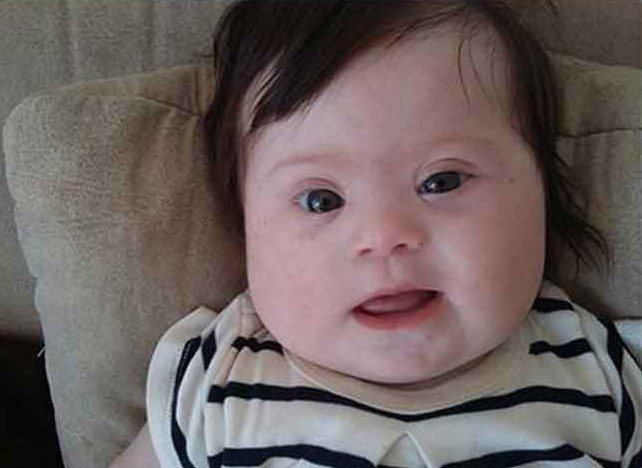 baby with down syndrome