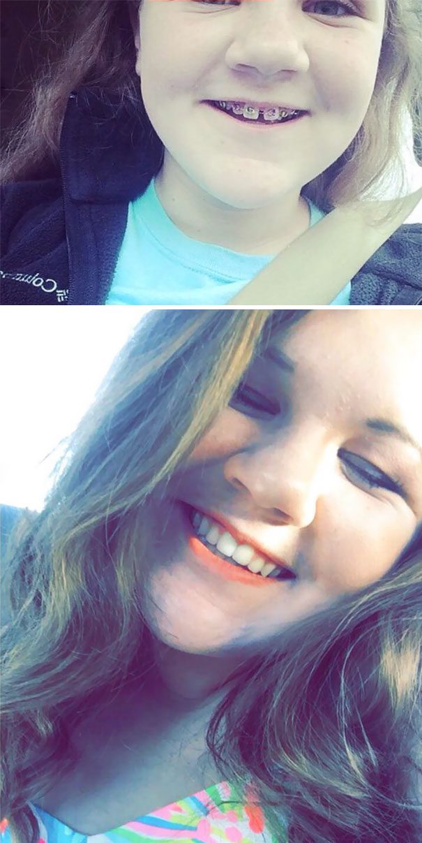 braces before and after